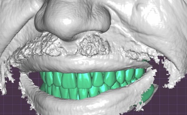 3D-Scanning vereinfacht und verbessert Zahnimplantatherstellung