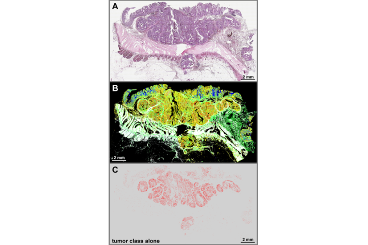 Thin-section images of colorectal cancer with H&E stain in A and label-free...